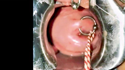 Extreme close-up cervix sounding with speculum and red rod insertion