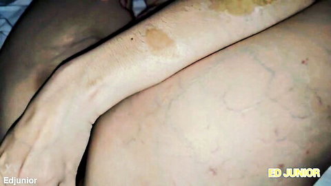 Closeup of pale woman's bare thighs and arm with veins and yellow bandage on bed